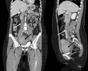 Enhanced computed tomography scan. Coronal (left) and sagittal (right) sections showing a filling defect image extending from the right atrium through the inferior vena cava (white arrow). A well-defined tumor arises from the uterus (black arrow).