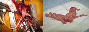 Operative view (left) and macroscopic view (right) of the tumor removed from the right atrium and inferior vena cava (dimensions 10.5 cm×4 cm×2.5 cm).