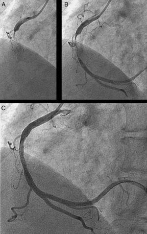 (A) Coronary angiogram showing occlusion of the right coronary artery; (B) an intraluminal thrombus observed in the middle segment of the artery after advancing the guidewire; (C) final result after thrombectomy and abciximab administration.