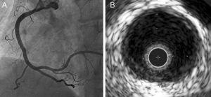 (A) Coronary angiogram five days after thrombectomy showing improvement of the vessel wall irregularities; (B) a mild concentric plaque without thrombus seen on intravascular ultrasound.
