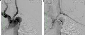 Aortografia revelando estenose da artéria subclávia esquerda (1A) e preenchimento retrógrado pela artéria vertebral homolateral (1B).