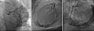 Angiografia coronária: ausência de doença coronária; calcificação marcada da silhueta cardíaca.