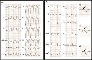 (A) 12-lead electrocardiogram (ECG) showing a wide QRS tachycardia, 190 bpm, left bundle branch block pattern with inferior axis, QS morphology in V1 and RS transition at V6; (B) 12-lead ECG after synchronized electric cardioversion revealing epsilon waves (arrows) in the right precordial leads and inverted T waves from V1 to V5.