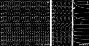 Electrophysiological study: (A) induction of ventricular tachycardia (VT) originating in the right ventricle and hemodynamic collapse; (B) defibrillation of the VT with 150-J biphasic shock (arrow) and post-shock sinus pause (arrowhead).