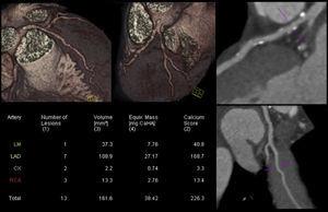 Coronary computed tomography angiography of a competitive Ironman veteran athlete with low cardiovascular risk based on SCORE (<1%), but with a higher than expected atherosclerotic burden (calcium score >percentile 90), with plaques in all the epicardial coronaries, including >5 segments with plaque (segment involvement score >5) and involvement of the left main and proximal left anterior descending arteries (adapted from Dores et al.38).