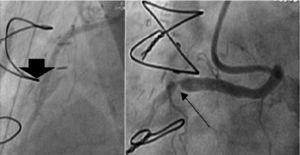 Patent right internal thoracic artery-right coronary artery (RCA) graft (large arrow) and anomalous RCA from the left sinus, with a surgically created proximal stenosis (thin arrow).