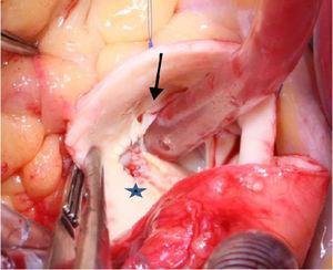 Fenestration of the anomalous left coronary artery (LCA), with creation of a neo-ostium (blue star). Note the small, slit-like anomalous opening of the LCA in the right sinus (black arrow).