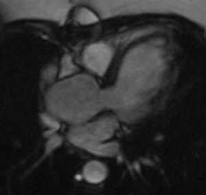 Long-axis three-chamber-view CMR of a 24-year-old patient with TS, showing dilatation of the ascending aorta, with ASI >2.5 cm/m2 indicating a high risk of dissection.