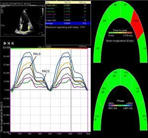 Two-dimensional left atrial speckle tracking analysis for the determination of left atrial (LA) strain: 4-chamber view depicting the corresponding LA strain curves for each of six segments analyzed in each view. Peak atrial longitudinal strain (PALS) is a measure of LA reservoir function and peak atrial contraction strain (PACS) is a marker of LA pump function. Conduit strain was calculated as the difference between PALS and PACS.