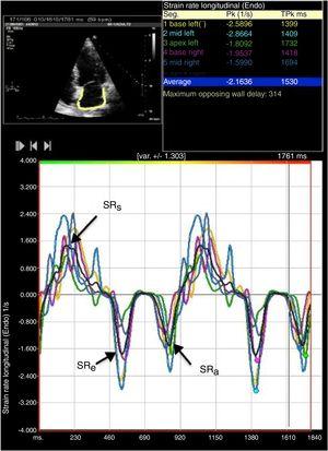 Two-dimensional left atrial (LA) speckle tracking analysis for the determination of left atrial strain rate: 4-chamber view showing LA strain rate curves for the six segments analyzed, with determination of peak strain rate during systole (SRs), peak strain rate during early diastole (SRe) and peak strain rate during atrial contraction (SRa).