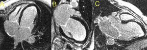 Cardiac magnetic resonance: no late enhancement detected in four- (A), two- (B) and three- (C) chamber views in late enhancement study.