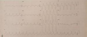 Eletrocardiograma a registar taquicardia ventricular monomórfica.
