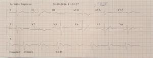 Eletrocardiograma com padrão de Brugada tipo 1 após teste de provocação farmacológica com ajmalina.