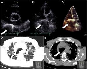 Transthoracic echocardiogram: parasternal short-axis view (A); two-dimensional apical 4-chamber view (B) and three-dimensional 4-chamber view (C) revealing a very large circular retroatrial mass, with irregular hyperechoic borders and hypoechoic center (arrow); thoracic high-resolution computed tomography, axial planes (D and E), revealing tracheobronchomegaly (arrow).
