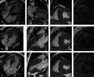 Cardiac magnetic resonance imaging (4-chamber, 2-chamber and short-axis cine and late gadolinium enhancement (LGE) views): (A, Case 1): asymmetric hypertrophic cardiomyopathy (HCM) with late gadolinium enhancement (LGE) in the hypertrophied segments; (B, Case 2): asymmetric HCM with LGE in the hinge points; (C, Case 3): asymmetric HCM with LGE in the hinge points.