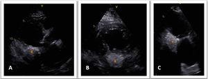 Two-dimensional transthoracic echocardiography: parasternal long-axis view (A), parasternal short-axis view (B) and apical 2-chamber view (C), revealing a hyperechogenic mass (star) at the base of the posterior leaflet with significant infiltration of the myocardium.