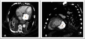 Computed tomography non-contrast acquisition images in axial (A) and sagittal (B) planes showing an elongated and grossly calcified mass in the mitral annulus (star) projecting into the left ventricular cavity.