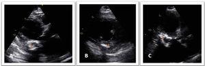 Two-dimensional transthoracic echocardiography, parasternal long-axis view (A), parasternal short-axis view (B) and apical 3-chamber view (C) revealing the calcified mass with hypoechoic areas (star).