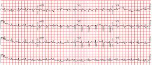 Eletrocardiograma na admissão no Serviço de Urgência demonstra taquicardia sinusal, desvio direito do eixo, bloqueio incompleto do ramo direito e inversão das ondas T na derivação III.