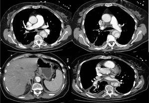 Angiotomografia de tórax demonstra pequeno trombo aderente no ramo esquerdo da artéria pulmonar e disseção da aorta, Stanford B, com início imediatamente após a crossa e que termina na aorta abdominal acima da emergência do tronco celíaco.