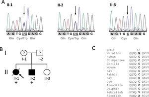 Mutation p.Cys57Trp in the TCAP gene. A: DNA sequencing electropherograms demonstrating heterozygosity for the detected mutation c.171C>G in individuals II-1 and II-2. The missense mutation is shown as two overlapping peaks (marked with an arrow). Individual II-3 exhibits a normal electropherogram (homozygous C). Codons are marked with gray blocks and the respective amino acid is shown below. B: Pedigree of the identified family. Squares represent males; circles females. Open symbols indicate unaffected individuals and solid symbols affected individuals; question marks, individuals with unknown status (without clinical data), and slanted bar, a deceased individual. The presence or absence of the mutation p.C57W is indicated by a plus and minus symbol, respectively. An arrow denotes the proband. C: Alignment of orthologs from eleven different species demonstrating high conservation in mammals (from chimp to dolphin) but no conservation in distantly related species such as fish. The mutated residue in the human sequence is underlined.