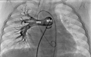Pulmonary angiography showing the absence of the left pulmonary artery branch. RPA: right pulmonary artery; MPA: main pulmonary artery.