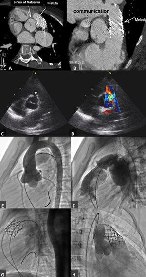 (A and B) Computed tomography showing the aortic end of the iatrogenic fistula near the right coronary ostium and the pulmonary end just proximal to the pulmonary valve; (C and D) transthoracic echocardiogram, parasternal long- and short-axis views of the iatrogenic fistula (*) between the aortic arch and the right ventricular outflow tract (RVOT); (E and F) aortic and conduit angiographies before percutaneous pulmonary valve implantation (PPVI); (G) conduit angiography after pre-stenting and after PPVI; (H) aortic angiography showing opacification of the RVOT.