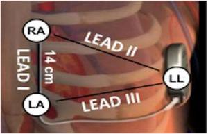 Diagram of subcutaneous implantable cardioverter-defibrillator lead vectors and placement of surface electrodes (white circles) during screening. The alternate lead vector extends from 1 cm left lateral of the xiphoid process (LA) to the fifth or sixth intercostal space along the left mid-axillary line (LL). The secondary lead vector extends from 14 cm cranially to the LA (RA) to the LL. The primary lead vector extends from RA to LA (images courtesy of Boston Scientific Corporation).
