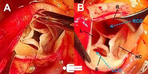 Surgical photographs (A and B) clearly showing a four-cusp aortic valve, with poor central coaptation and two independent ostia. The supernumerary leaflet was the smallest and the others were of equal size (type B and III according to Hurwitz and Roberts’3 and Nakamura et al.’s6 classifications, respectively). The left coronary ostium was close to and tunneled under the commissure. L: left coronary cusp; LCO: left coronary ostium; NC: non-coronary cusp; R: right coronary cusp; RCO: right coronary ostium; S: supernumerary cusp.