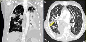 Chest computed tomography showing multiple nodular opacities and an incipient halo sign secondary to invasive pulmonary aspergillosis (yellow arrow).