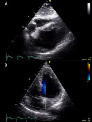 Post-procedure echocardiogram, subcostal view, revealing a well-positioned permanent pacemaker lead (A); no shunt was detected between the right and left chambers (B).