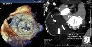 Measurement of anatomic characteristics of the leak by three-dimensional transesophageal echocardiography and computed tomography angiography.