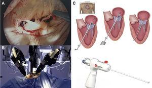 Minimally invasive mitral valve procedures. (A) Endoscopic view from a right minithoracotomy, showing ruptured chordae of P2 segment; (B) Da Vinci robot; (C) surgical steps of chordal implantation with the Harpoon device (left anterior minithoracotomy in beating heart without extracorporeal circulation72).