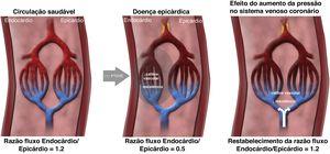 Mecanismo de ação da redução do seio coronário (PTDVE ‐ pressão telediastólica do ventrículo esquerdo)46.