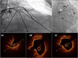 Baseline angiogram and optical coherence tomography (OCT) evaluation. A severe, calcified lesion is seen in distal left main artery (star) with severe stenosis over left anterior descending artery (LAD) and ramus intermedius. OCT images reveal a calcium arc >180° with calcium nodules over proximal LAD (f=Figure 1A).