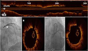 Optimal angiographic result after left anterior descending artery and distal left main artery percutaneous coronary intervention with appropriate stent expansion and apposition demonstrated in optical coherence tomography post procedural evaluation.