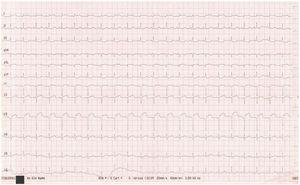 Electrocardiogram at admission showed Q waves end ST-elevation in anterior and lateral chest leads.