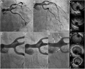 Baseline and follow-up angiographies and intravascular ultrasound. (A, B) Baseline coronary angiography showed a coronary mass in distal left main coronary artery (white asterisks); Online-Video 1. (C-D) Baseline intravascular ultrasound showed a large intraluminal mass, presenting a variable gray scale with speckling, suggestive of thrombus. (E-G) Progressive and complete thrombus dissolution on coronary angiographies; Online-Video 2-4. (H-J) Final intravascular ultrasound demonstrated the absence of thrombus and atherosclerotic disease.