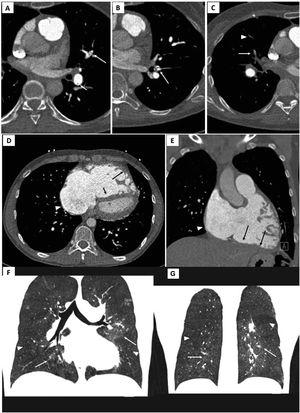 Electrocardiogram-gated pulmonary computed tomography (CT) angiography of patients with chronic thromboembolic pulmonary hypertension. Upper panel: A) and B) axial images showing hypodense linear structures forming webs and bands, inside the lumen of arteries, consistent with residual thrombus; C) demonstrates luminal opacities and marked caliber reduction of segmental vessels, suggesting subtotal lesion, as well as marked stenosis of more distal, subsegmental vessels (arrowhead). Middle panel: D) Pulmonary CT angiography depicting right atrial dilation (arrowheads) and leftward deviation of the interventricular septum (short arrow) yielding a “D-shaped” left ventricle. D and E) right ventricular dilation and hypertrophy (long arrows show free wall thickening) with marked myocardial trabeculation. Lower panel: F and G) Mosaic pattern of lung attenuation. The hypoperfused (oligemic) lung appears lower in attenuation (arrowheads) than adjacent normal perfused lung (arrows).
