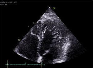 Transthoracic echocardiogram of the index patient showing myocardial hypertrabeculation in apical 4-chamber view, clearly fulfilling the Stöllberger diagnostic criteria for LVNC.