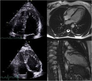 Transthoracic echocardiogram (left) and cardiac magnetic resonance imaging (right) from the 47-year-old sister (top) and the 41-year-old sister (bottom) of the index patient, both fulfilling the Stöllberger and Petersen diagnostic criteria of left ventricular noncompaction.