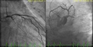 Coronary angiography showing total occlusion of proximal left circumflex artery with high thrombotic burden.