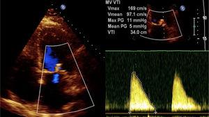 Postprocedural transthoracic echocardiography. Apical four chamber view showing a persistent improvement of mitral regurgitation to mild grade (color doppler 1+) after successful MitraClip deployment, without significant increase of transmitral gradient (mean gradient 5 mmHg).