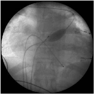 Fluoroscopic image showing the position of the noncontact multielectrode diagnostic catheter and of the ablation catheter in the right ventricle outflow tract (postero-anterior view).