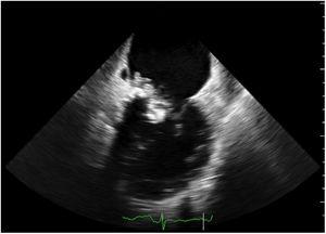 Transesophageal echocardiogram showing a large mass on the mitral valve.