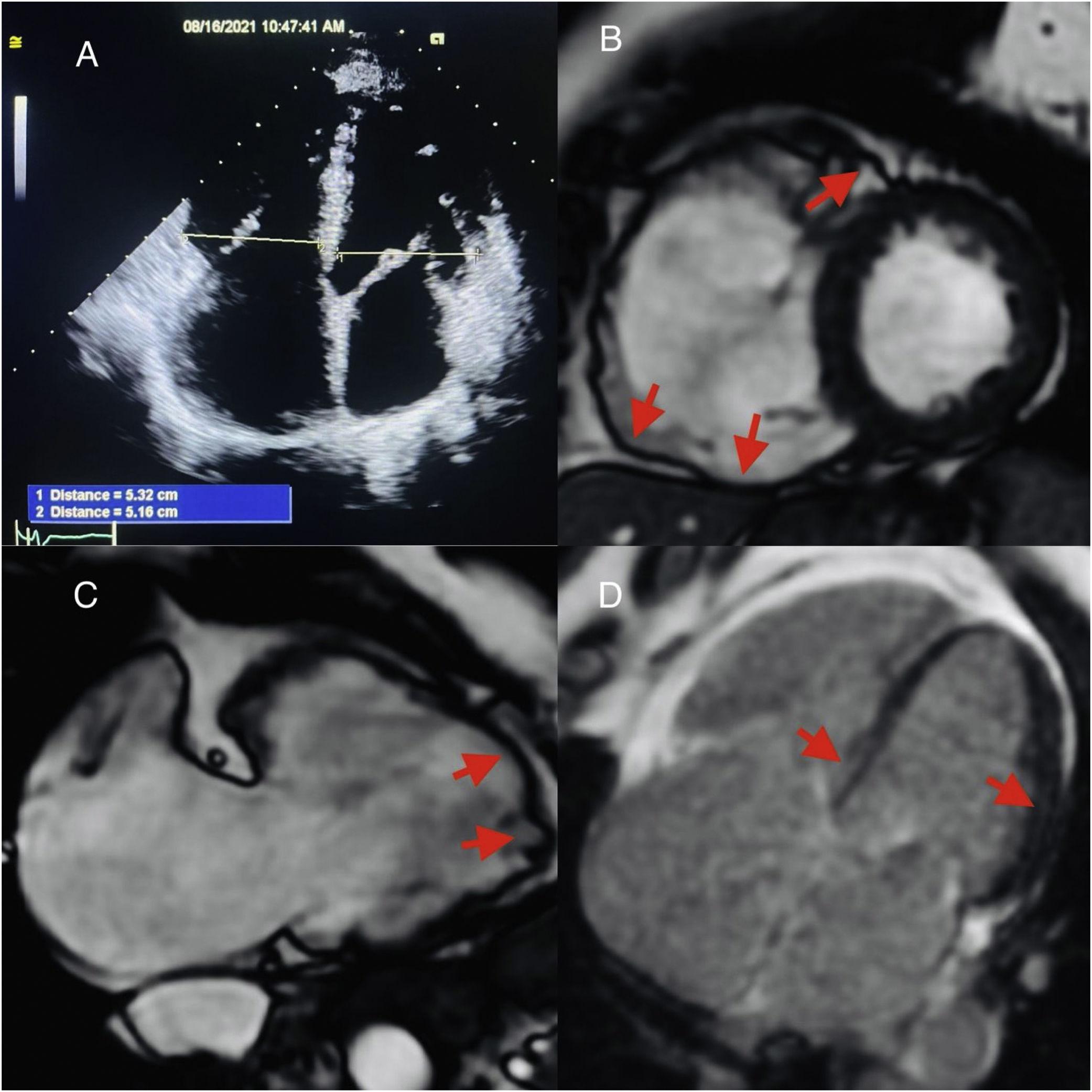 The uniqueness of cardiac magnetic resonance imaging in arrhythmogenic  right ventricular cardiomyopathy