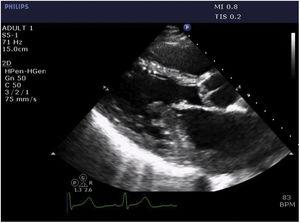 Parasternal long-axis view (1) and apical 4-chamber view (2) on transthoracic echocardiography showing multiple, mobile, echogenic masses in the left atrium invading the left ventricle and mitral and aortic valves.