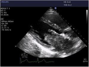Parasternal long-axis view on transthoracic echocardiography showing a broad-based mass adhering to the posterior wall of the left atrium and partially prolapsing into the left ventricle.