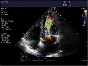 Color Doppler in apical 4-chamber view on transthoracic echocardiography displaying increased forward blood flow through the mitral valve during diastole, indicating mitral inflow obstruction caused by the mass.
