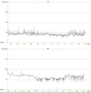 Heart rate trends before (above) and nine months after (below) cardioneuroablation, showing an improvement on average throughout the 24 hours.